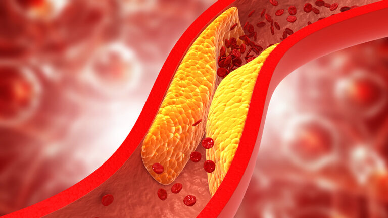 Die Cholesterin Lüge